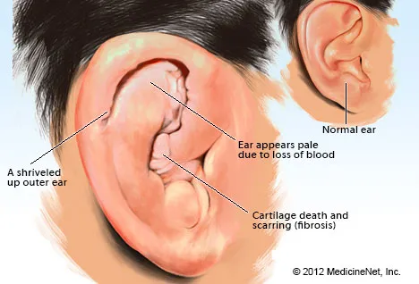 Picture of Cauliflower Ear