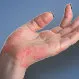 Psoriatic Arthritis Quiz